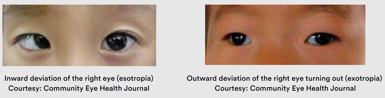 Inward deviation of the right eye (esotropia) and Outward deviation of the right eye turning out (exotropia) Courtesy: Community Eye Health Journal