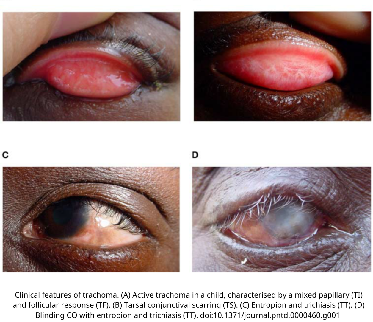 Four images showing different stages of trachoma. Image A shows inflamed inner eyelid, image B shows advanced inflammation with follicles, image C shows scarring of the inner eyelid, and image D shows an eye with trichiasis and corneal opacity.