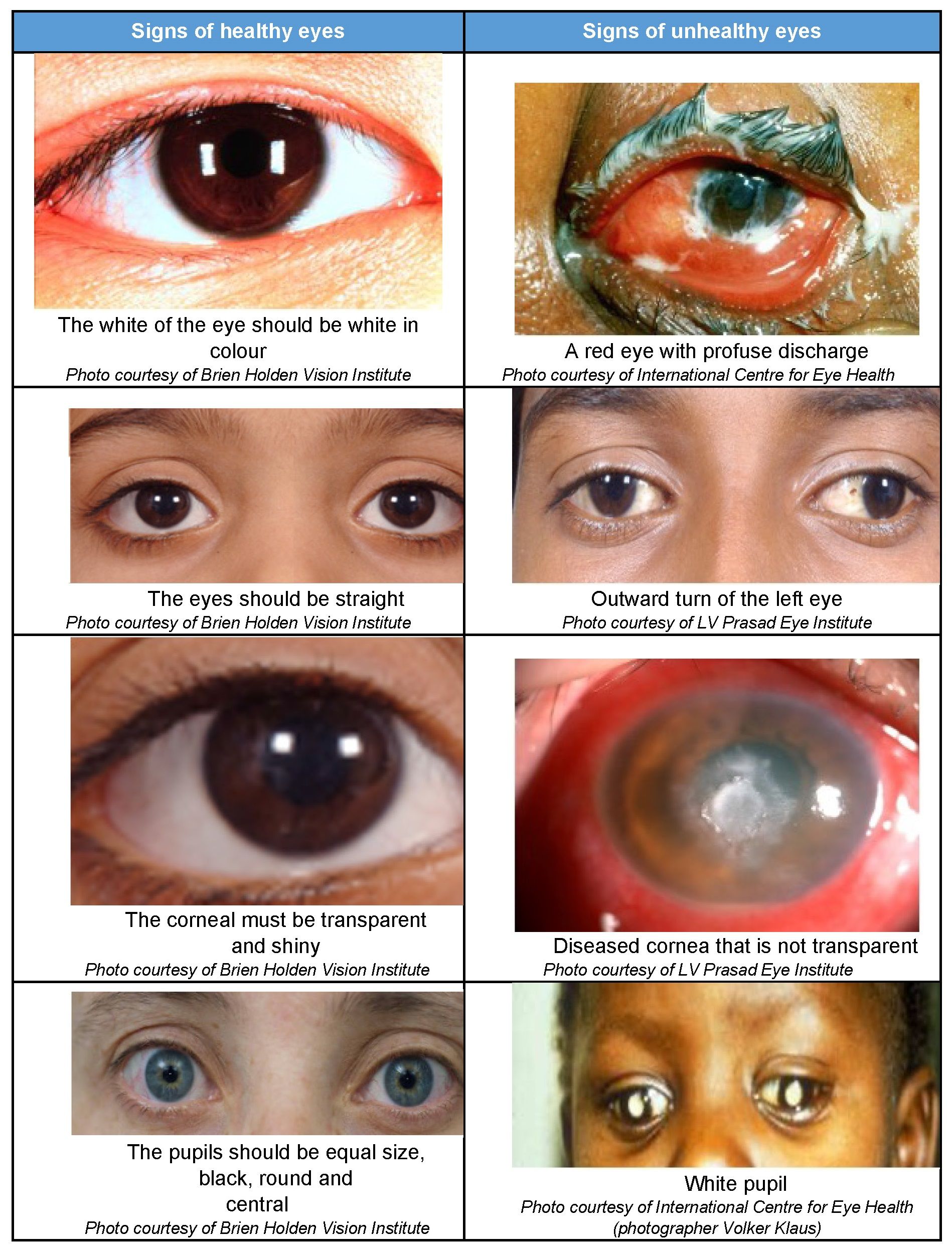 A comparison chart showing signs of healthy and unhealthy eyes.